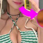 Bintang Korea Terkejut Dengan Perbandingan Sebelum dan Sesudah Operasi Philtrum dan Sudut Bibir